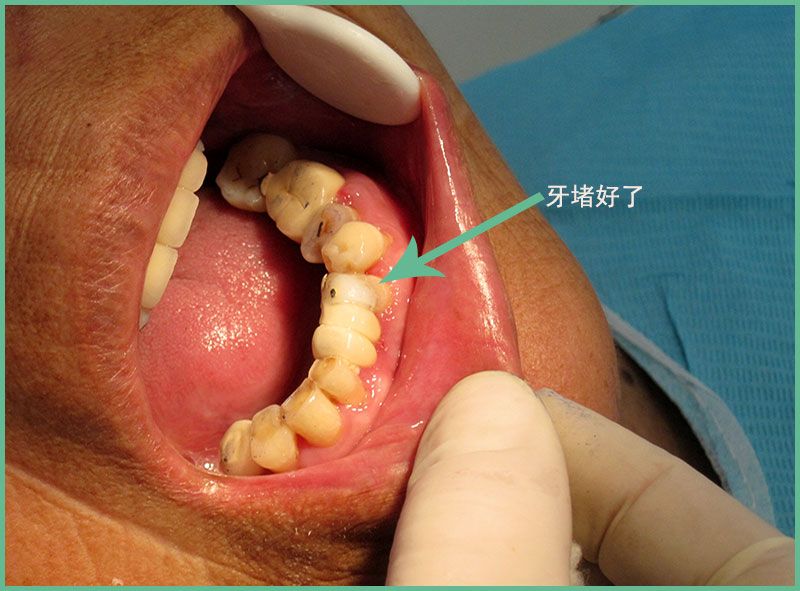 迁安杜玉华口腔牙科-杜玉华医师为客户堵牙2.jpg