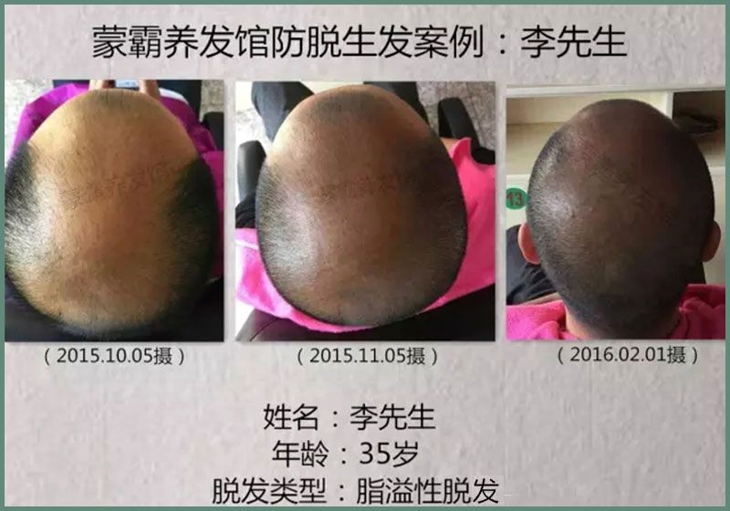 迁安蒙霸绿色养发会馆-实际案例前后对比5.jpg