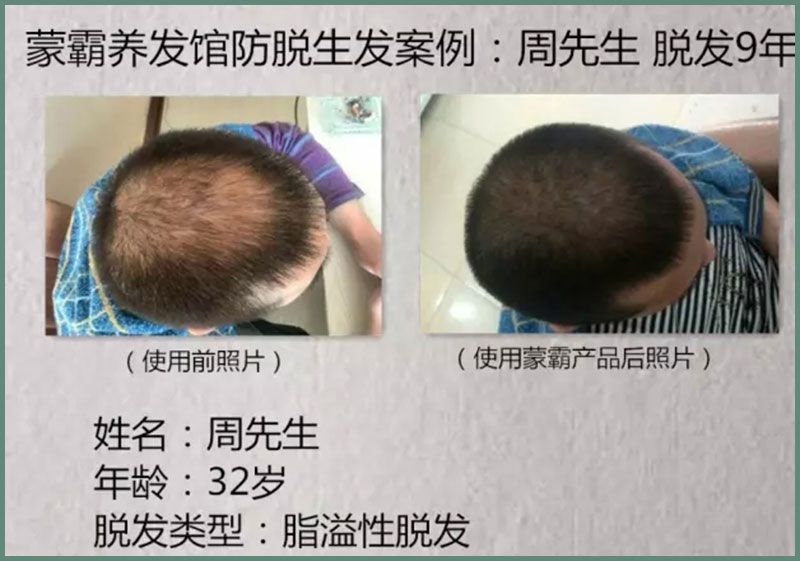 迁安蒙霸绿色养发会馆-实际案例前后对比6.jpg