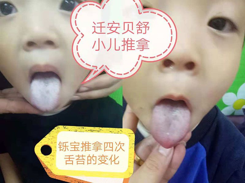 迁安贝舒小儿推拿-推拿四次后舌苔变化-1.jpg