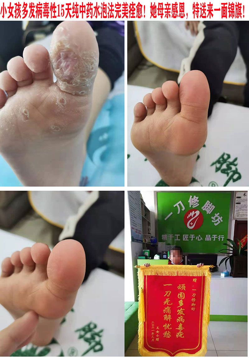 病毒疣中药水泡法完美治愈.jpg